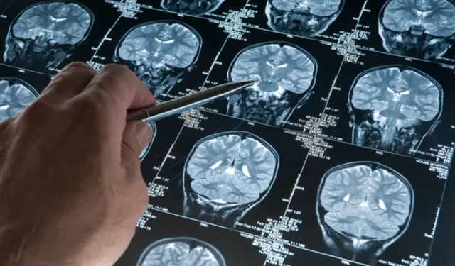 AB, "tarihi" Alzheimer ilacını onaylamadı: Faydaları riskleri telafi edecek kadar yeterli değil