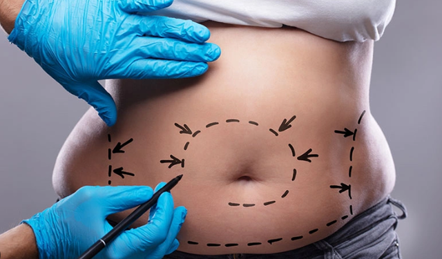 Liposuction hakkında doğru bilinen yanlışlar