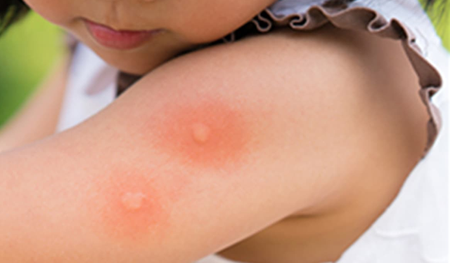Uzmanından 'böcek sokmalarında ölümcül alerjik riski var' uyarısı